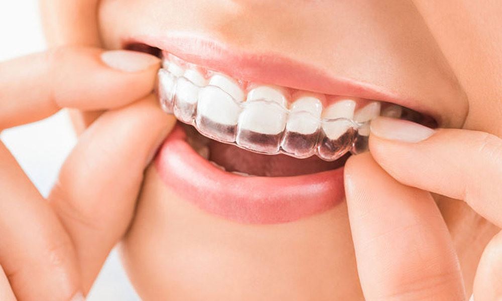 Clear Aligners