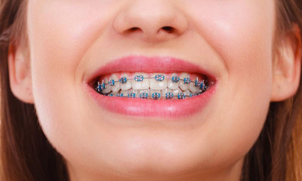 Metal Braces