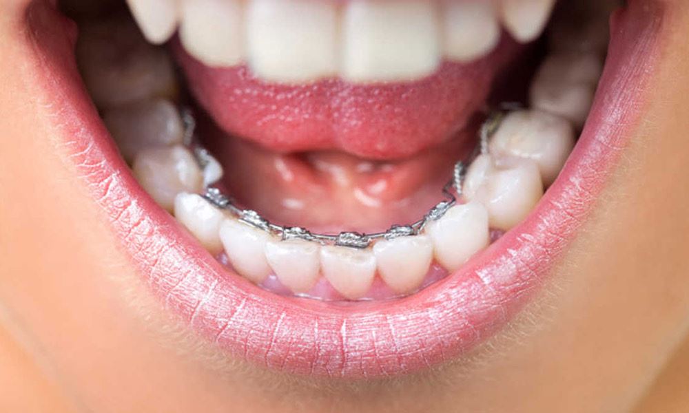 Lingual Braces