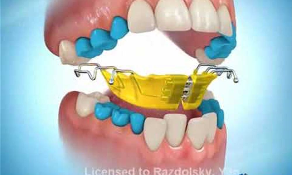 Mandibular Expander Removable