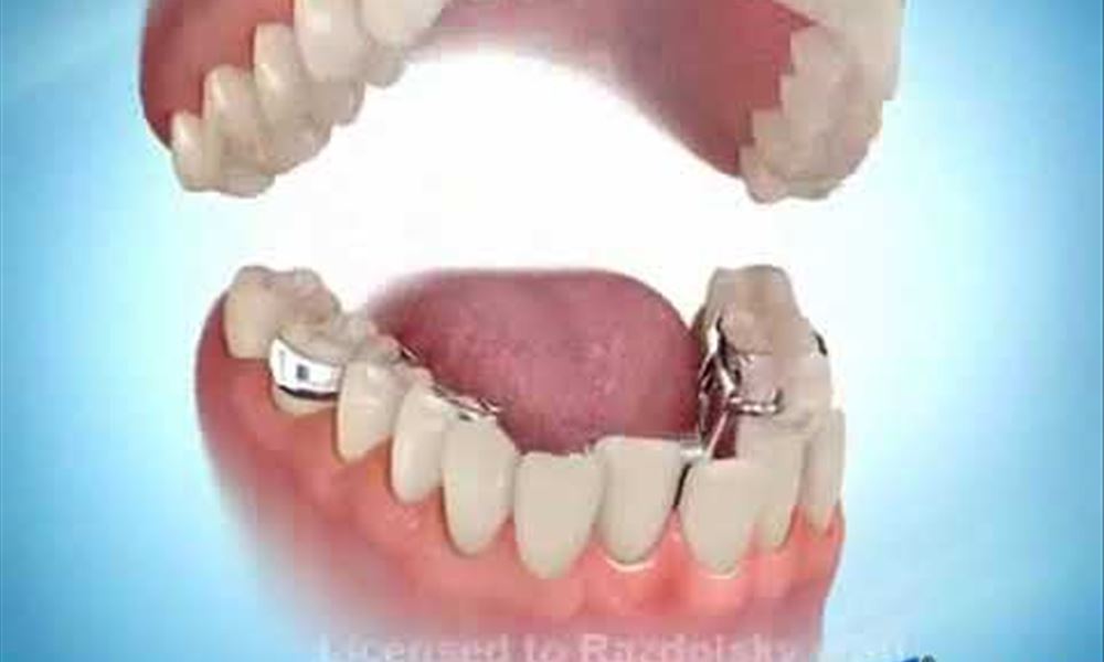 Fixed Lower Expander