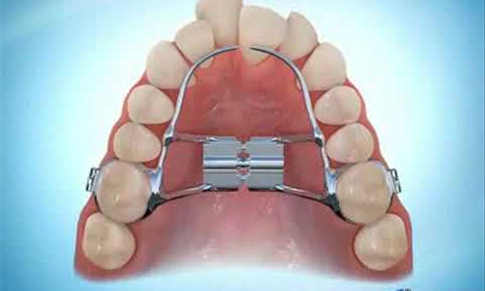Rapid Palatal Expansion During Braces