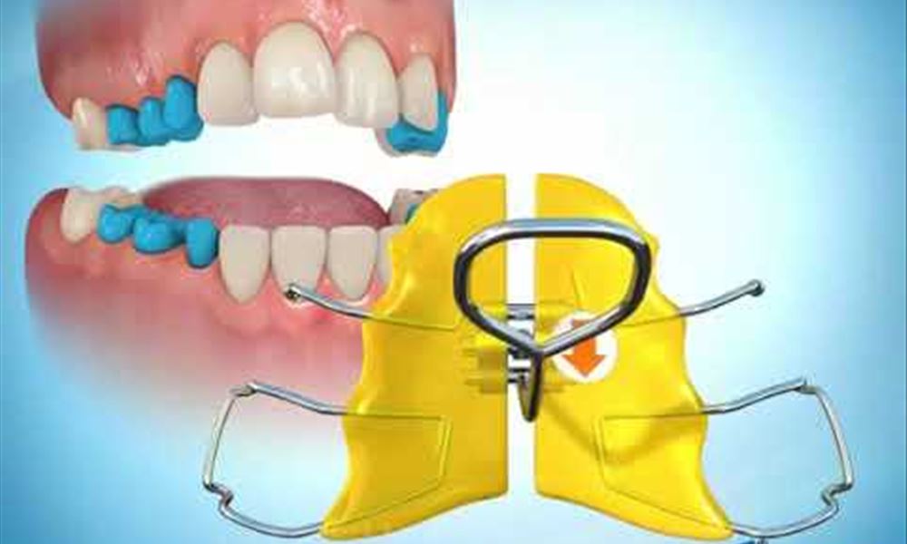 Maxillary Expander Removable
