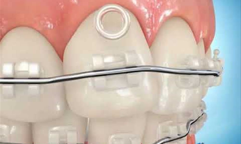 clear brackets and clear o tie