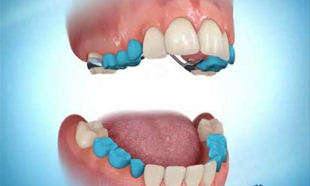 Quad Helix Appliance