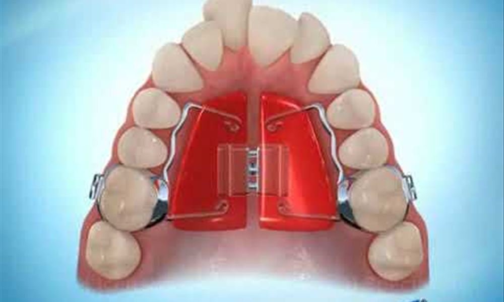 Haas Rapid Palatal Expansion During Braces