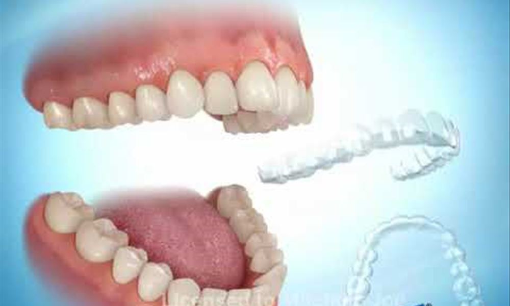 Type Invisalign Invisible Aligners