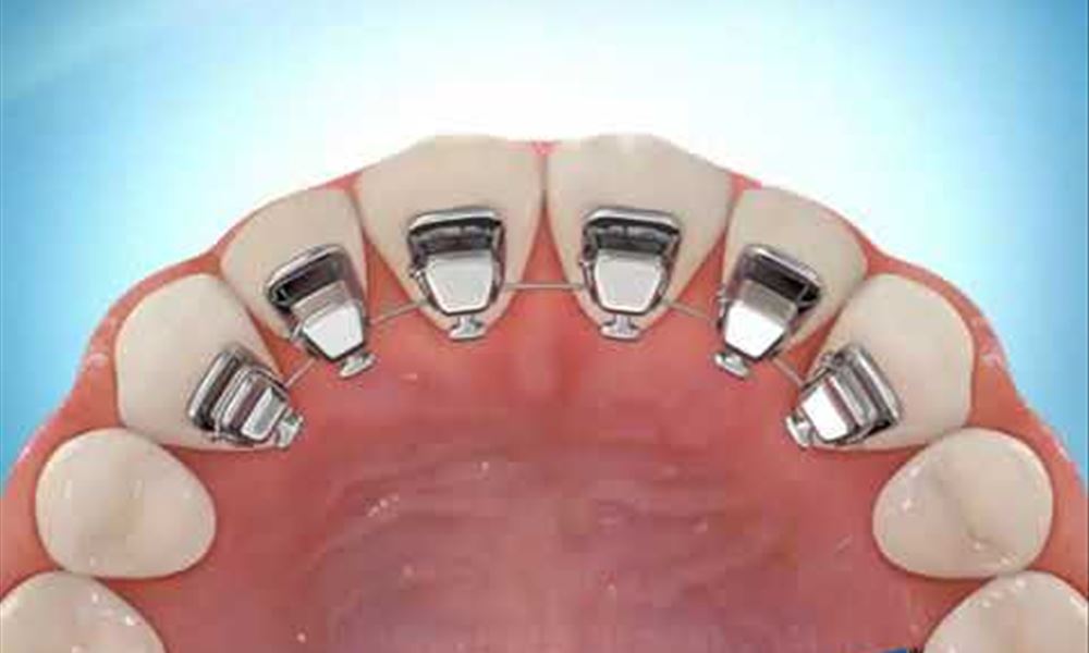 Lingual Braces Placement