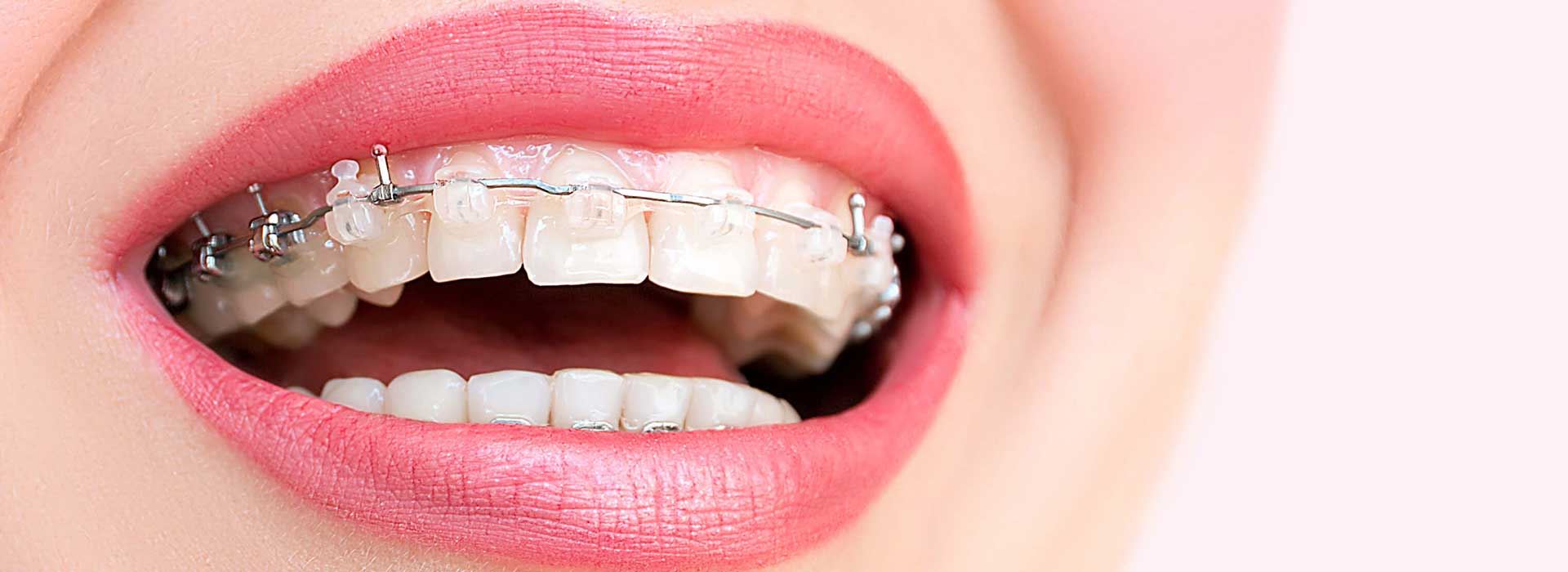 Ceramic (transparent) Braces