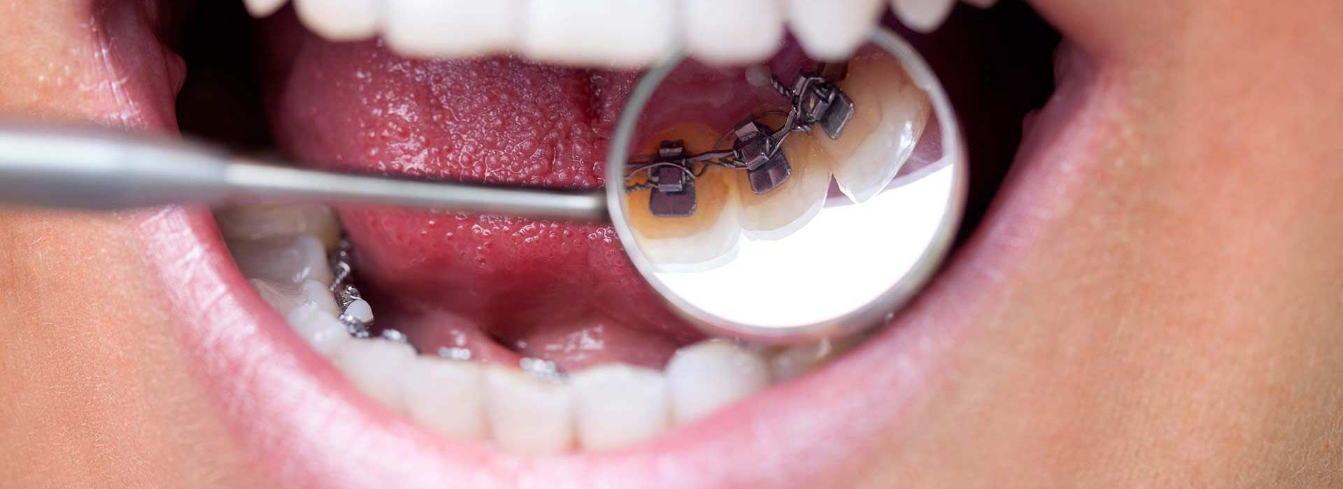 Lingual Braces