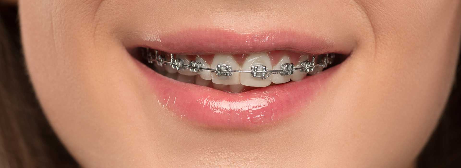 Metal Braces