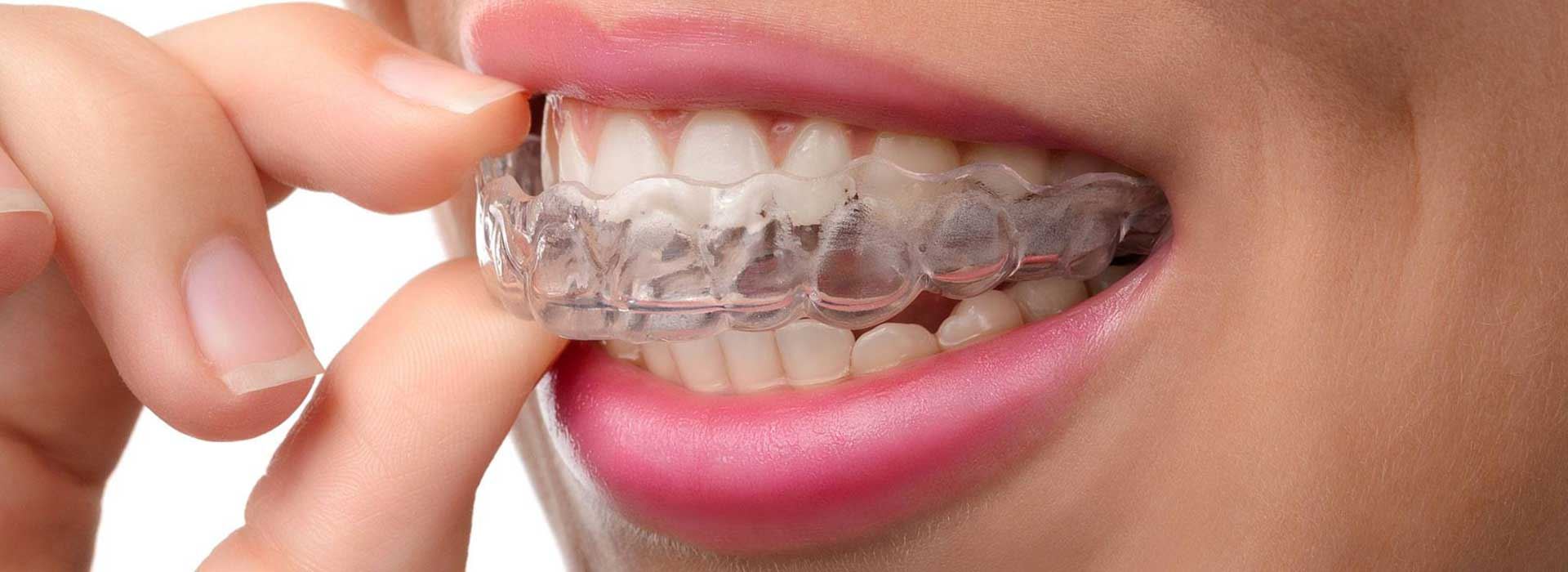 Clear Aligners